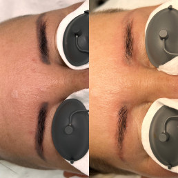 Eyebrow tattoo laser removal