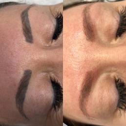 Eyebrow tattoo laser removal