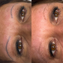 Eyebrow tattoo laser removal