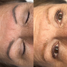 Eyebrow tattoo laser removal