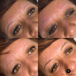 Eyebrow tattoo laser removal